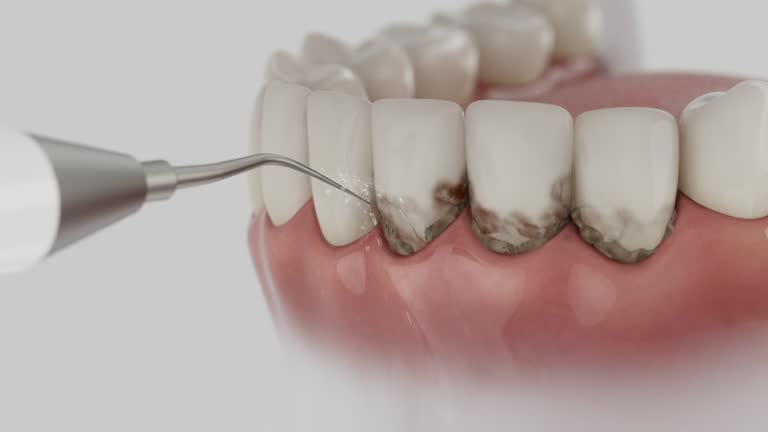 Trusted Wisdom Tooth Removal service in Carmichael, CA - Dentist Open Now